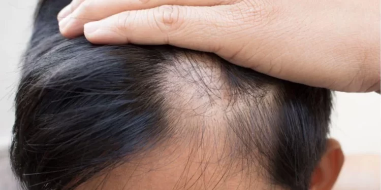 5 Penyebab Rambut Rontok Pada Anak_womanindonesia.co.id