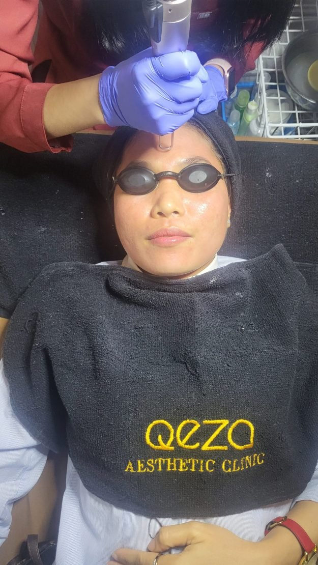 Mengatasi Hiperpigmentasi dengan Pico Laser Rejuve dan Melasma Shoot di Qeza Aesthetic Clinic_Womanindonesia.co.id