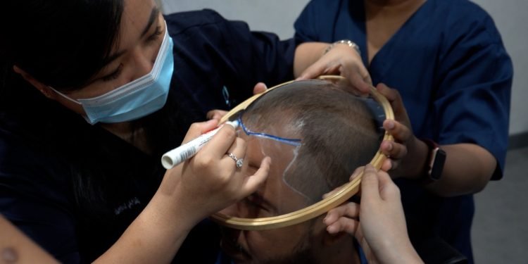 Gak perlu Ke Turki, kini Transplantasi Rambut bisa Dilakukan di Indonesia_womanindonesia.co.id